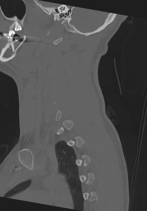 Cervical intercalary bone (Radiopaedia 35211-36748 Sagittal bone window 18).png
