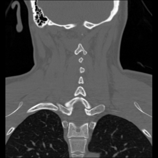 File:Cervical rib (Radiopaedia 71110-81363 Coronal non-contrast 18).jpg
