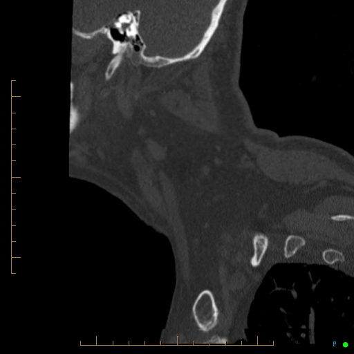 Cervical spine fracture - ankylosing spondylitis (Radiopaedia 76835-88706 Sagittal bone window 104).jpg