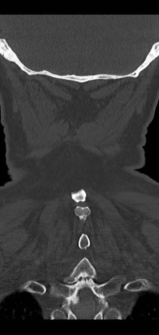 Cervical spine fracture - chalk stick (Radiopaedia 39116-41323 Coronal bone window 45).png