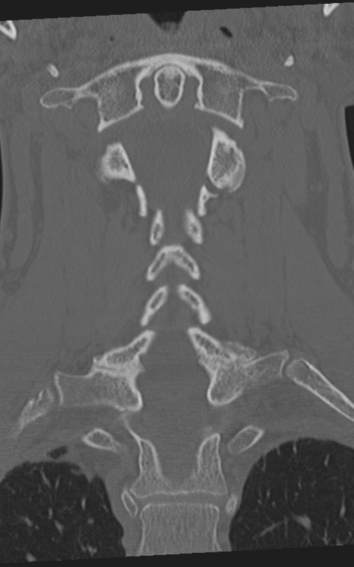 Cervical spine fractures with vertebral artery dissection (Radiopaedia 53296-59268 Coronal bone window 38).png