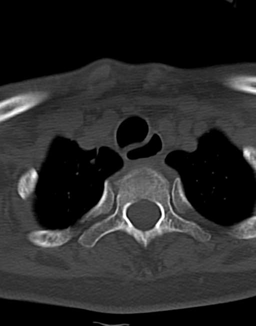 Cervical tuberculous spondylitis (Radiopaedia 39149-41365 Axial bone window 50).png