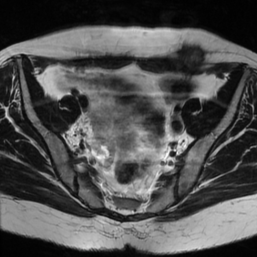 File:Cesarian section scar endometriosis (Radiopaedia 66520-75799 Axial T2 7).jpg