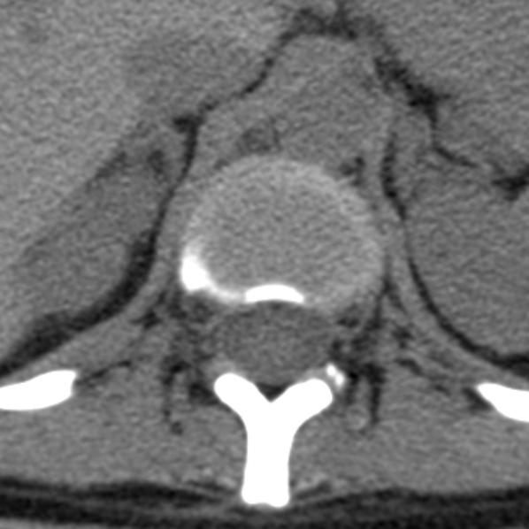 File:Chance fracture (Radiopaedia 36521-38081 Axial non-contrast 60).jpg