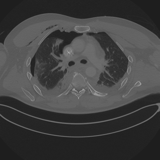 Chest multitrauma - aortic injury (Radiopaedia 34708-36147 Axial bone window 123).png