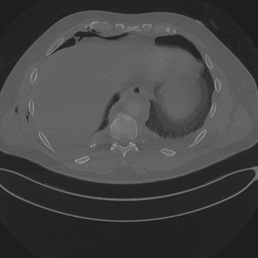 Chest multitrauma - aortic injury (Radiopaedia 34708-36147 Axial bone window 236).png