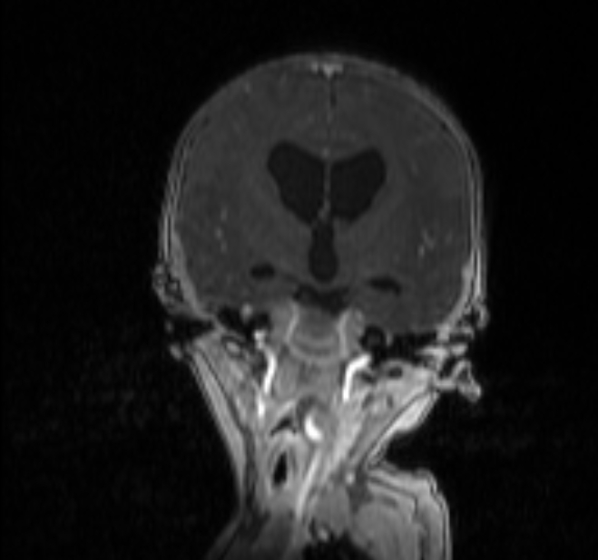 Chiari III malformation with occipital encephalocele (Radiopaedia 79446-92559 Coronal T1 C+ mpr 14).jpg