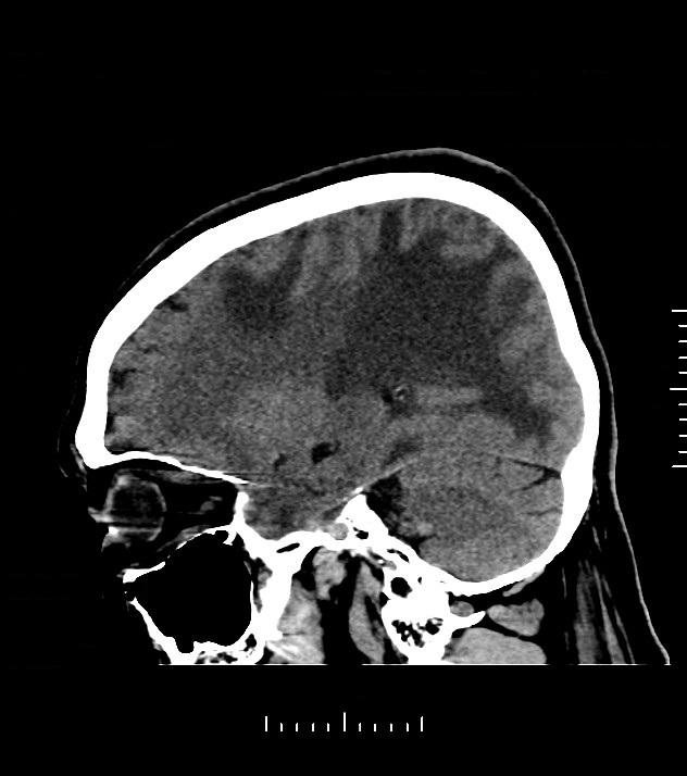 Cholangiocarcinoma with cerebral metastases (Radiopaedia 83519-98628 C 18).jpg