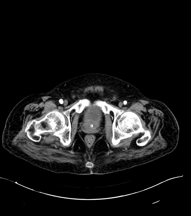 Cholangiocarcinoma with cerebral metastases (Radiopaedia 83519-98629 B 122).jpg