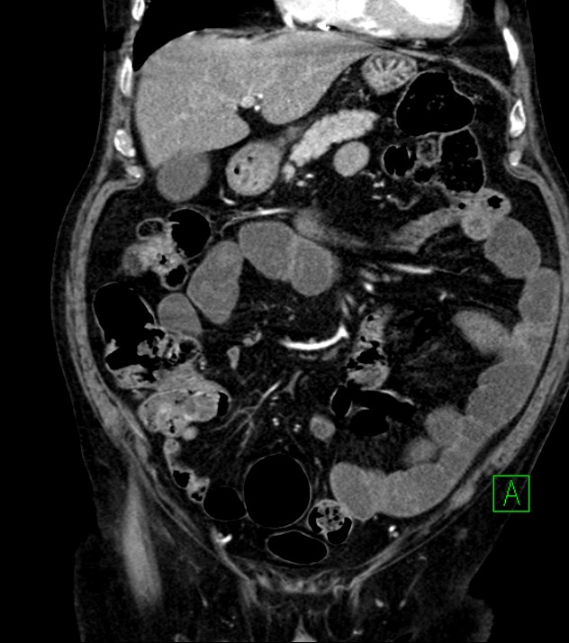Cholangiocarcinoma with cerebral metastases (Radiopaedia 83519-98629 E 33).jpg