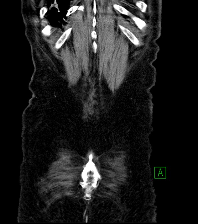 Cholangiocarcinoma with cerebral metastases (Radiopaedia 83519-98629 G 77).jpg