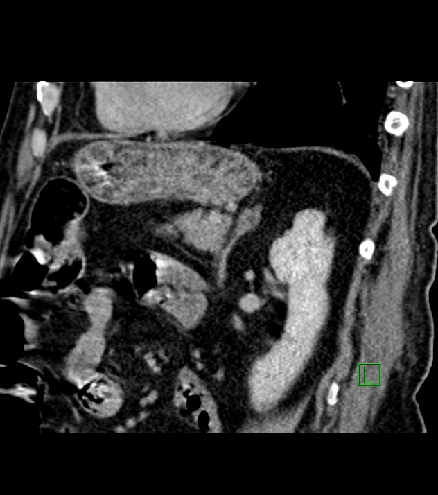 Cholangiocarcinoma with cerebral metastases (Radiopaedia 83519-98629 Sagittal C+ delayed 40).jpg