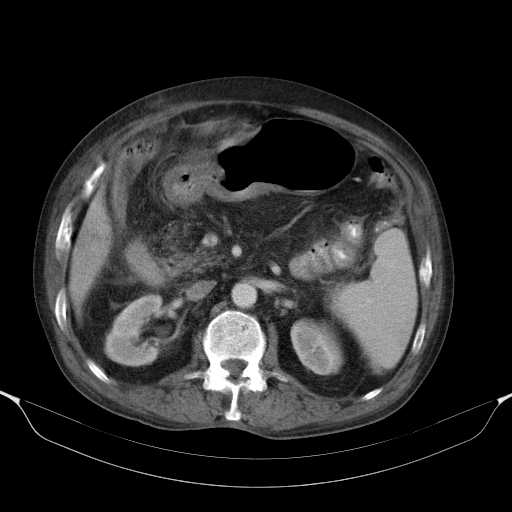 File:Cholangitis and abscess formation in a patient with cholangiocarcinoma (Radiopaedia 21194-21100 A 21).jpg