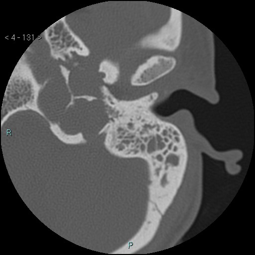 Cholesterol granuloma of the petrous apex (Radiopaedia 64358-73141 Axial bone window 63).jpg