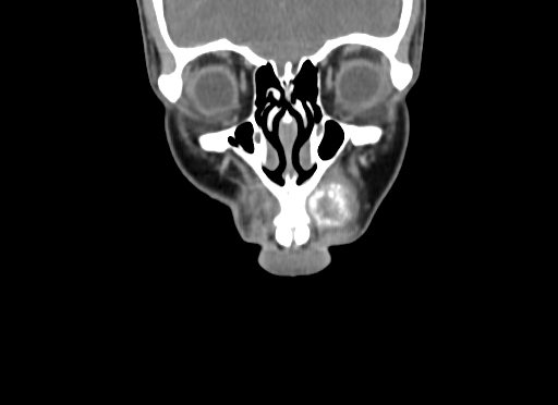 Chondroblastic osteosarcoma (Radiopaedia 67363-76741 D 18).jpg