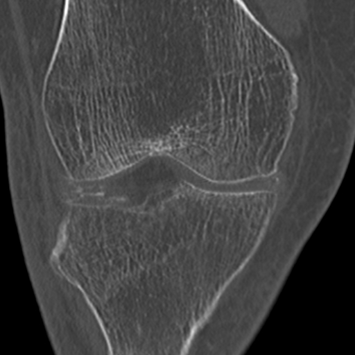 Chondrocalcinosis (Radiopaedia 16275-15955 Coronal bone window 26).jpg