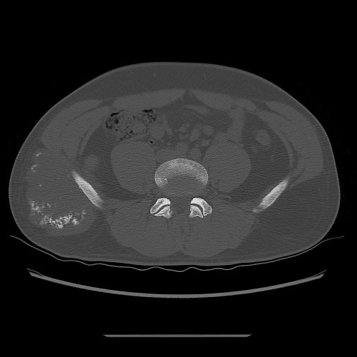 File:Chondrosarcoma of iliac wing (Radiopaedia 63861-72599 Axial bone window 33).jpg
