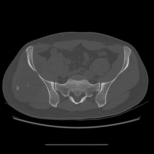 File:Chondrosarcoma of iliac wing (Radiopaedia 63861-72599 Axial bone window 56).jpg
