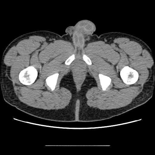 Chondrosarcoma of iliac wing (Radiopaedia 63861-72599 Axial non-contrast 126).jpg