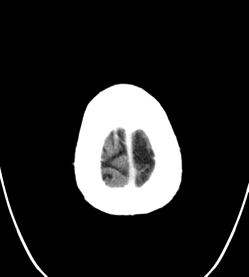 File:Chondrosarcoma of skull base- grade II (Radiopaedia 40948-43653 Axial Contrast 29).png