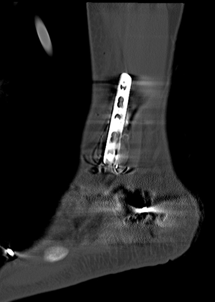 Chopart fracture (Radiopaedia 35347-36861 Sagittal bone window 59).jpg