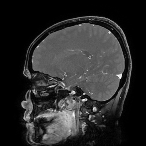 File:Chordoid glioma of third ventricle (Radiopaedia 91612-109340 F 85).jpg