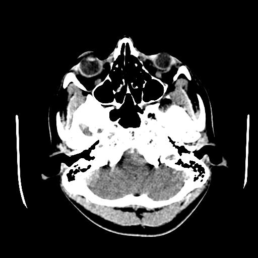 File:Choriocarcinoma of ovary with cerebral and pulmonary metastases (Radiopaedia 25983-26118 C+ arterial phase 16).jpg