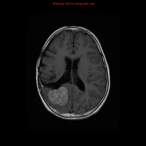 File:Choroid plexus carcinoma - recurrent (Radiopaedia 8330-9169 Axial T1 C+ 14).jpg