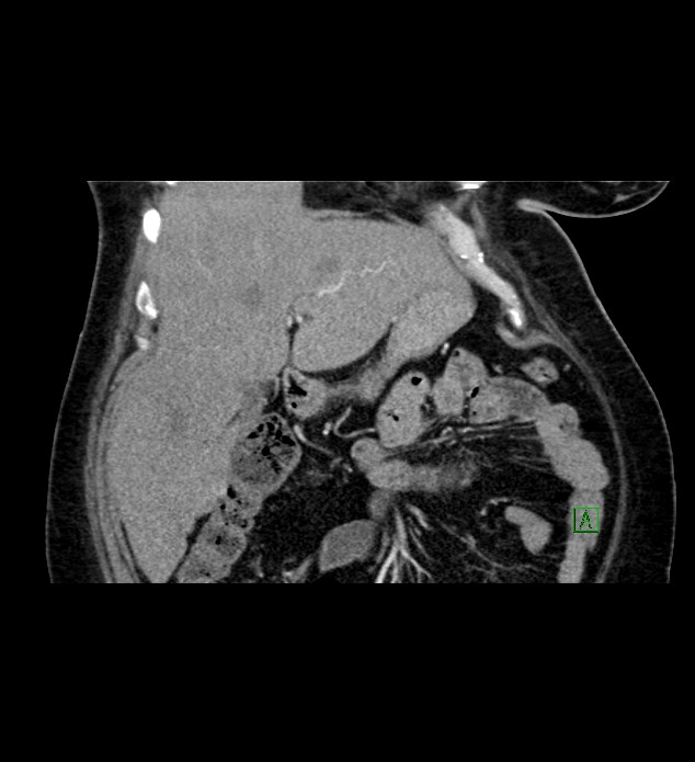 Chromophobe renal cell carcinoma (Radiopaedia 84239-99519 C 29).jpg