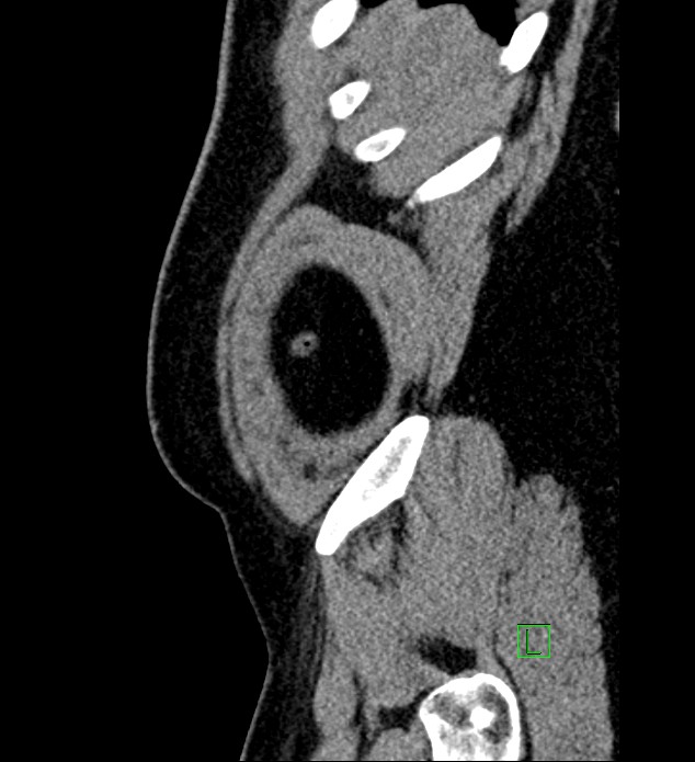 Chromophobe renal cell carcinoma (Radiopaedia 84286-99573 C 179).jpg