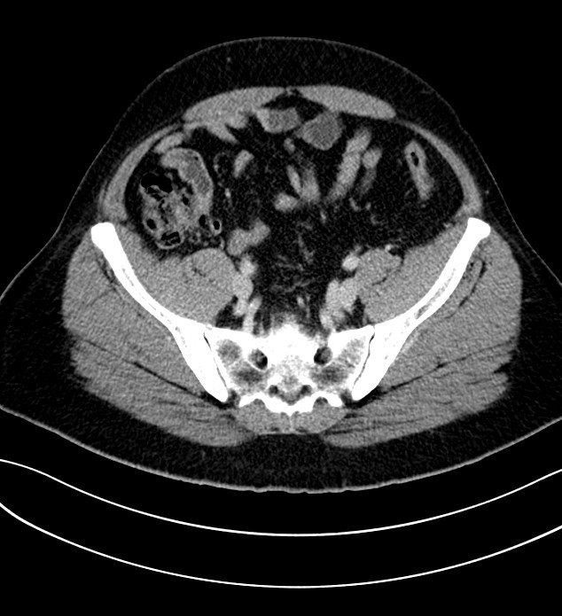 Chromophobe renal cell carcinoma (Radiopaedia 84286-99573 G 56).jpg