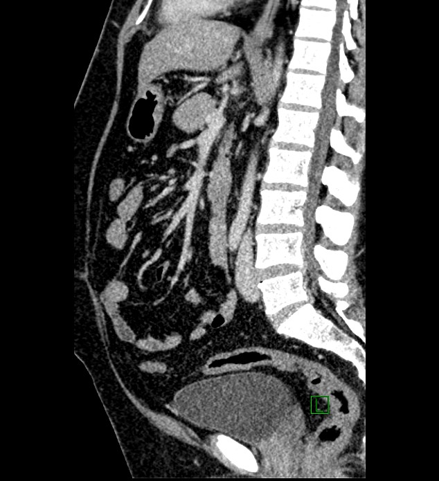 Chromophobe renal cell carcinoma (Radiopaedia 84286-99573 I 90).jpg