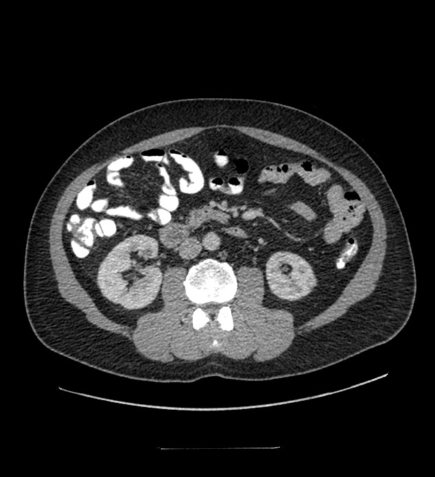 Chromophobe renal cell carcinoma (Radiopaedia 84337-99644 C 63).jpg