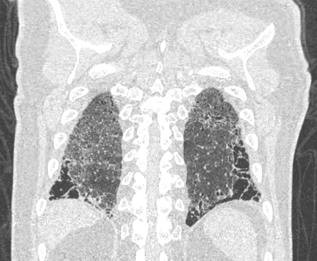 File:Chronic hypersensitivity pneumonitis (Radiopaedia 48107-52922 Coronal lung window 23).png