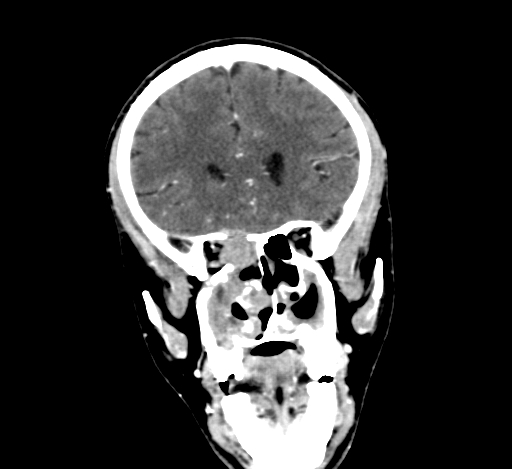 Chronic invasive fungal sinusitis with intraorbital and intracranial extension (Radiopaedia 56387-63046 C 131).jpg
