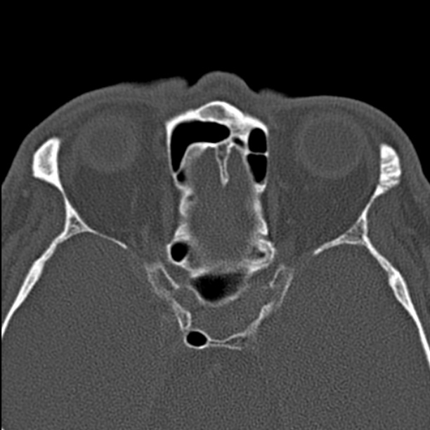 Chronic maxillary sinusitis (Radiopaedia 27879-28116 Axial bone window 39).jpg