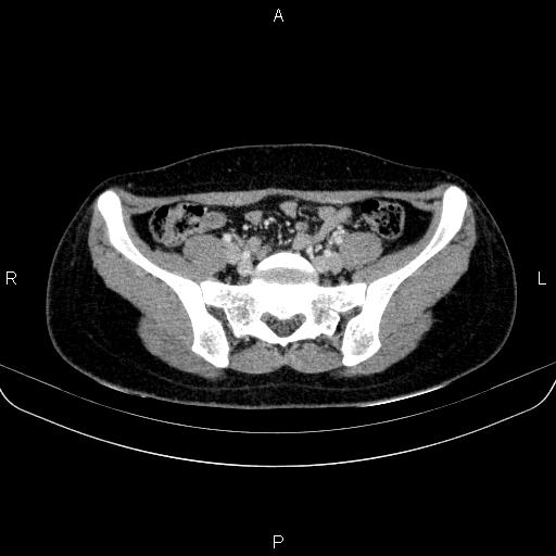 Chronic mesenteric nonspecific lymphadenitis (Radiopaedia 84910-100414 B 76).jpg