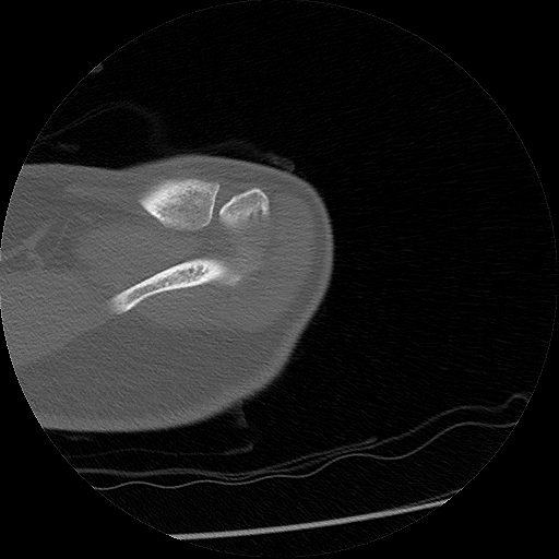 Chronic osteomyelitis (Radiopaedia 67597-76998 Axial bone window 2).jpg