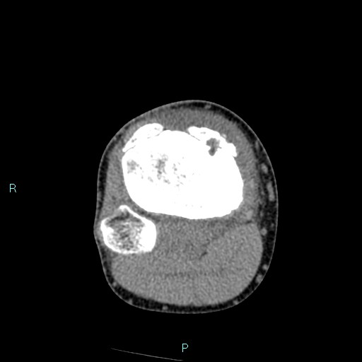 Chronic osteomyelitis (with Brodie abscess) (Radiopaedia 76405-88111 A 84).jpg