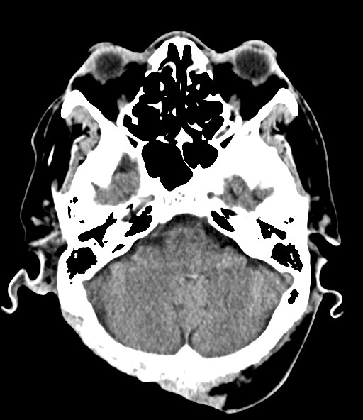 File:Chronic osteomyelitis - calvarial (severe) (Radiopaedia 69668-79616 Axial non-contrast 32).jpg
