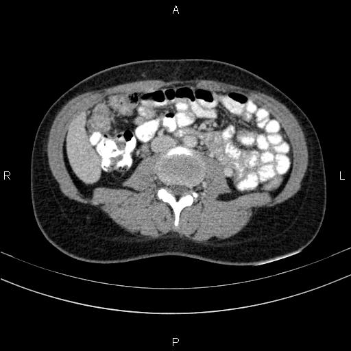 Chronic pancreatitis (Radiopaedia 64576-73450 C 91).jpg