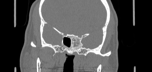 File:Chronic sphenoidal sinusitis (Radiopaedia 62030-70122 Coronal bone window 117).jpg