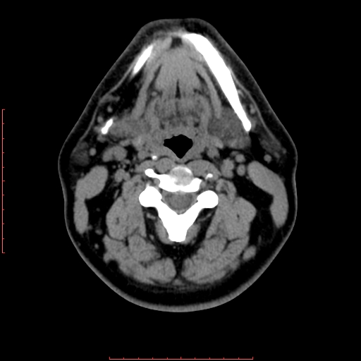 Chronic submandibular sialolithiasis (Radiopaedia 69817-79814 Axial non-contrast 114).jpg