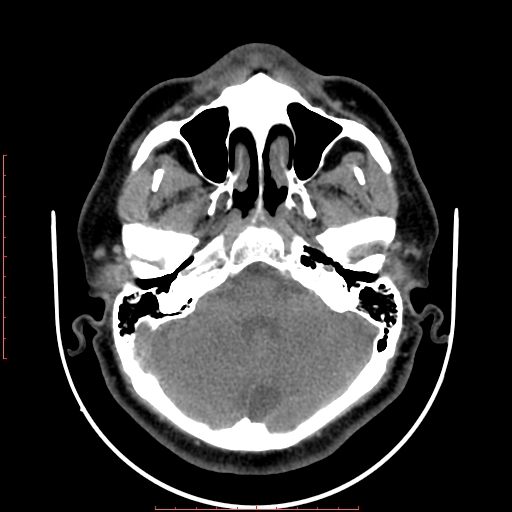 Chronic submandibular sialolithiasis (Radiopaedia 69817-79814 Axial non-contrast 8).jpg