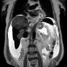 File:Cirrhosis and hepatocellular carcinoma in the setting of hemochromatosis (Radiopaedia 75394-86594 Coronal T2 17).jpg