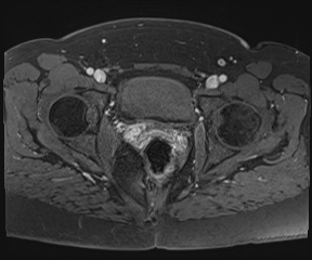 File:Class II Mullerian duct anomaly- unicornuate uterus with rudimentary horn and non-communicating cavity (Radiopaedia 39441-41755 Axial T1 fat sat 102).jpg