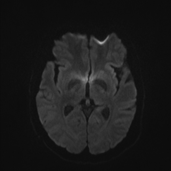 File:Clival meningioma (Radiopaedia 53278-59248 Axial DWI 37).jpg