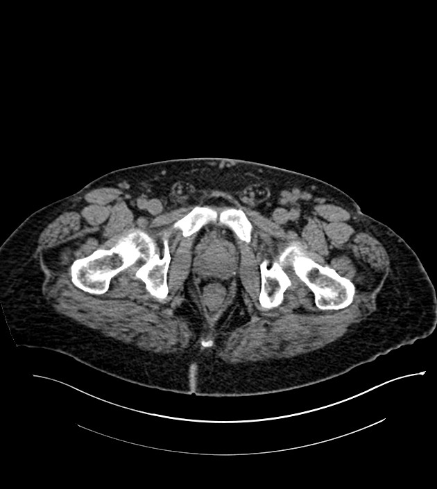 Closed-loop small bowel obstruction-internal hernia (Radiopaedia 78439-91096 Axial non-contrast 154).jpg