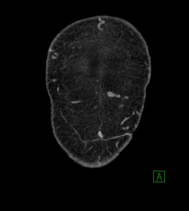 Closed-loop small bowel obstruction-internal hernia (Radiopaedia 78439-91096 Coronal non-contrast 11).jpg