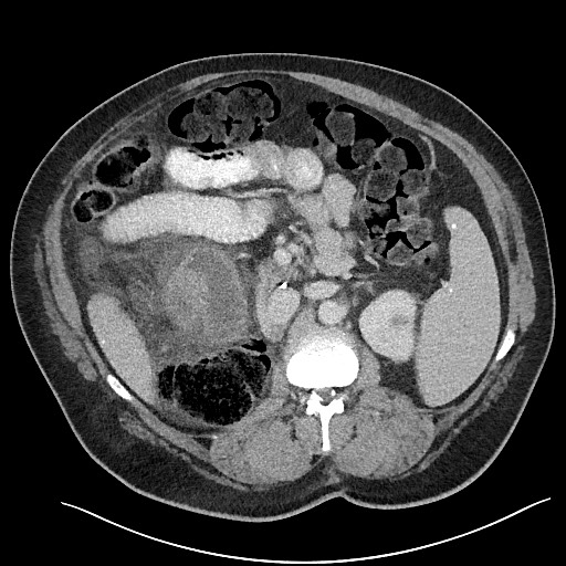 File:Closed loop obstruction - internal hernia into nephrectomy bed (Radiopaedia 59867-67320 Axial 37).jpg